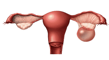 Cysts Tumor